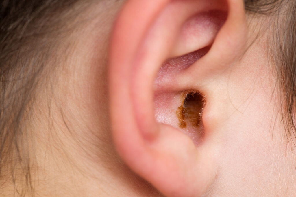 Person from essex Ear wax build up in ear