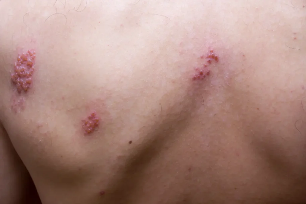doctor pointing to Herpes zoster