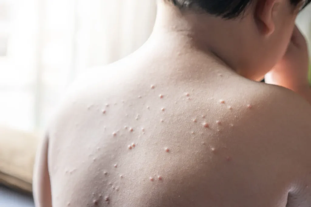 child with chickenpox on back