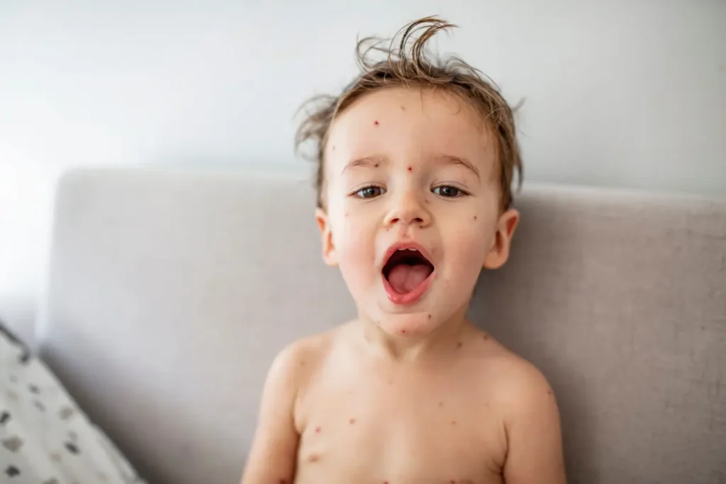 Sick child with chickenpox.