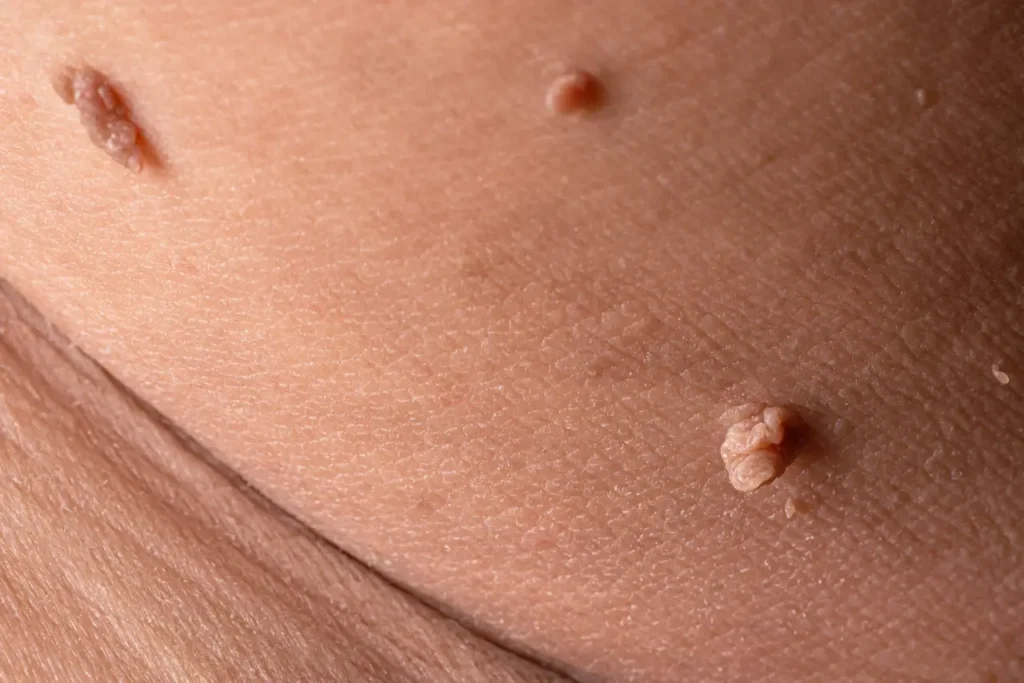 skin tags on skin