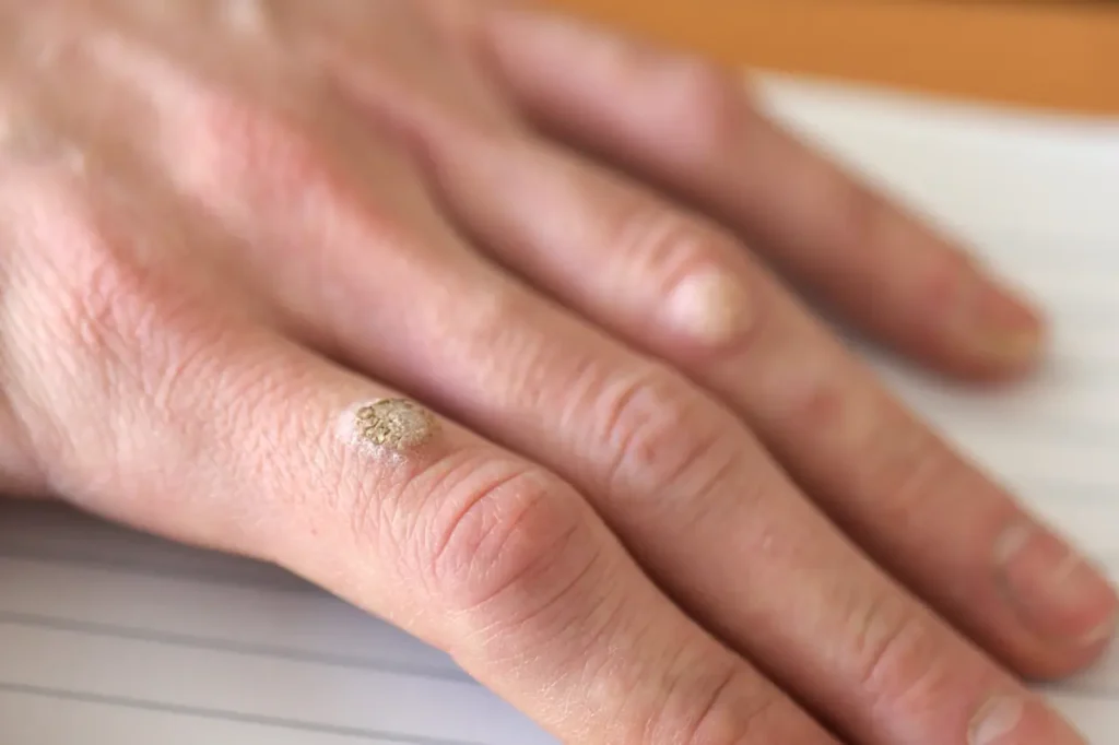 Wart on the hand finger.