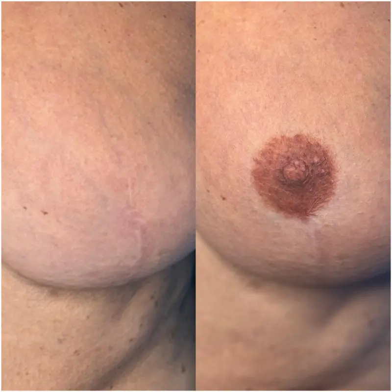 Image on before and after medical tattooing of breast